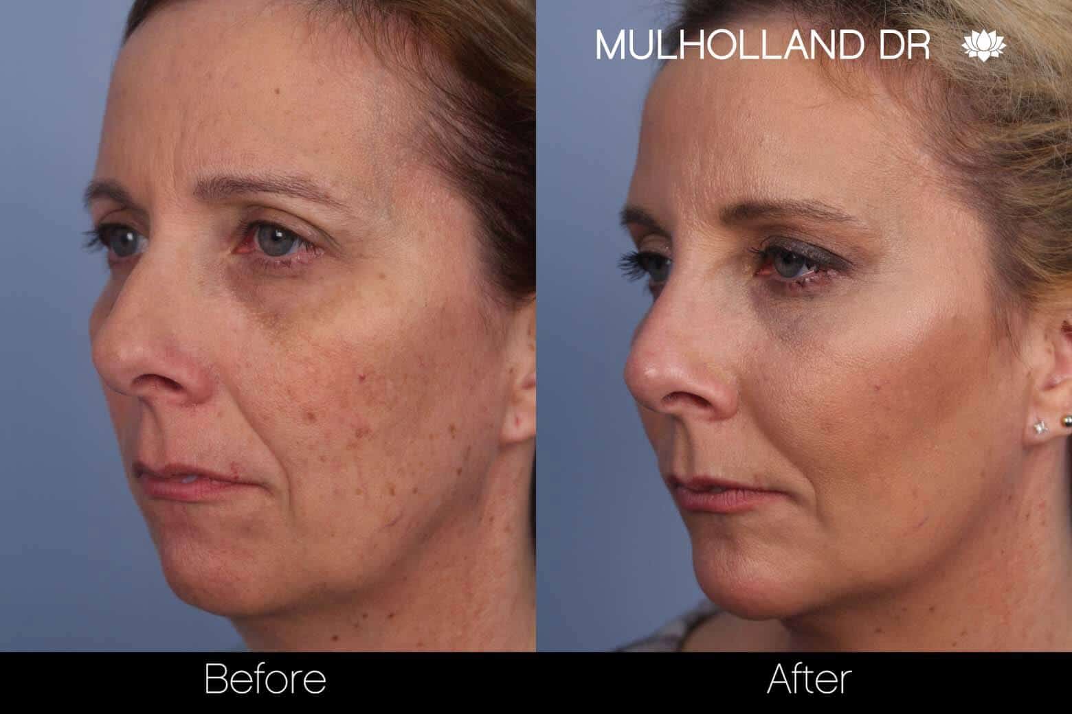 Microdermabrasion - Before and After Gallery – Photo 2