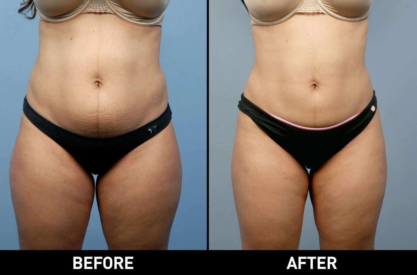 Smart Lipo - Before and After Gallery – Photo 12