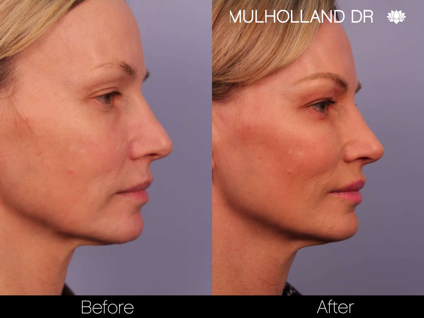 Lip Augmentation- Before and After Gallery – Photo 2