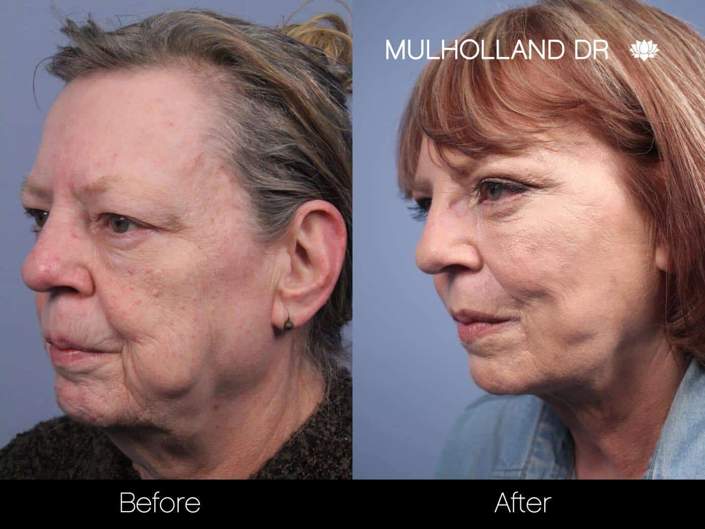 Non-Surgical Facelift - Before and After Gallery – Photo 13