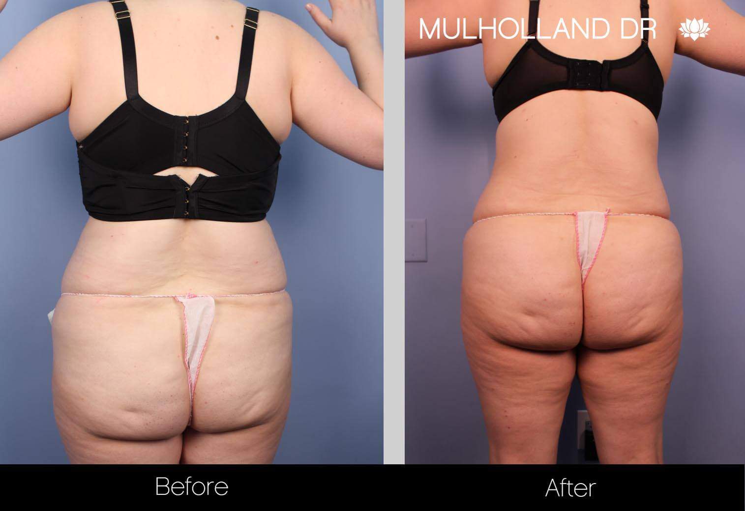 Vaser Lipo - Before and After Gallery – Photo 14
