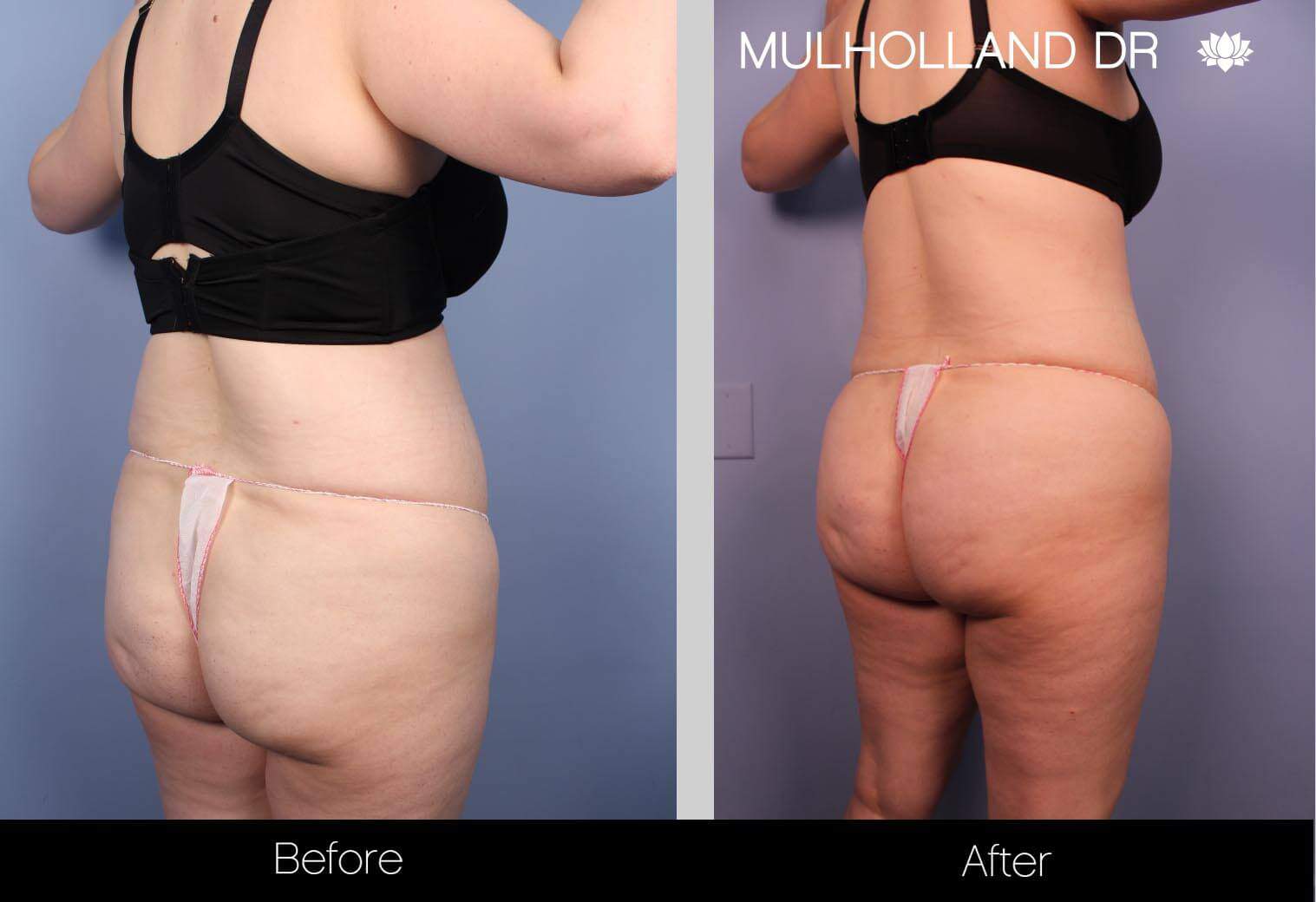 Vaser Lipo - Before and After Gallery – Photo 15