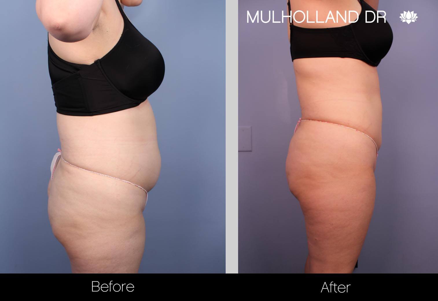 Vaser Lipo - Before and After Gallery – Photo 16