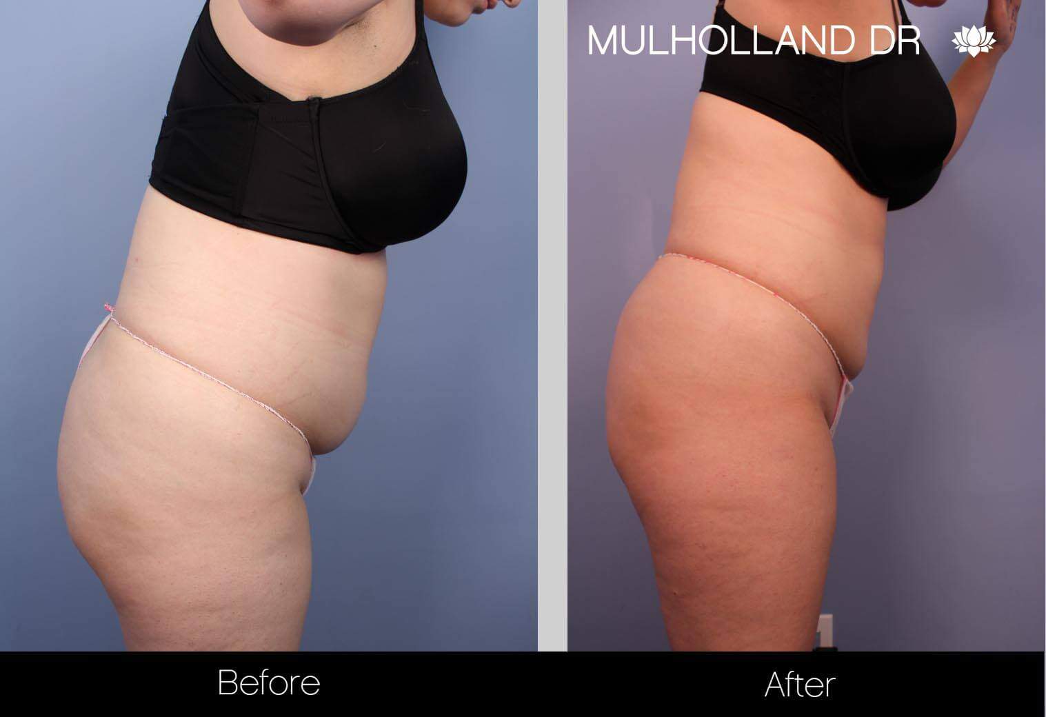 Vaser Lipo - Before and After Gallery – Photo 17