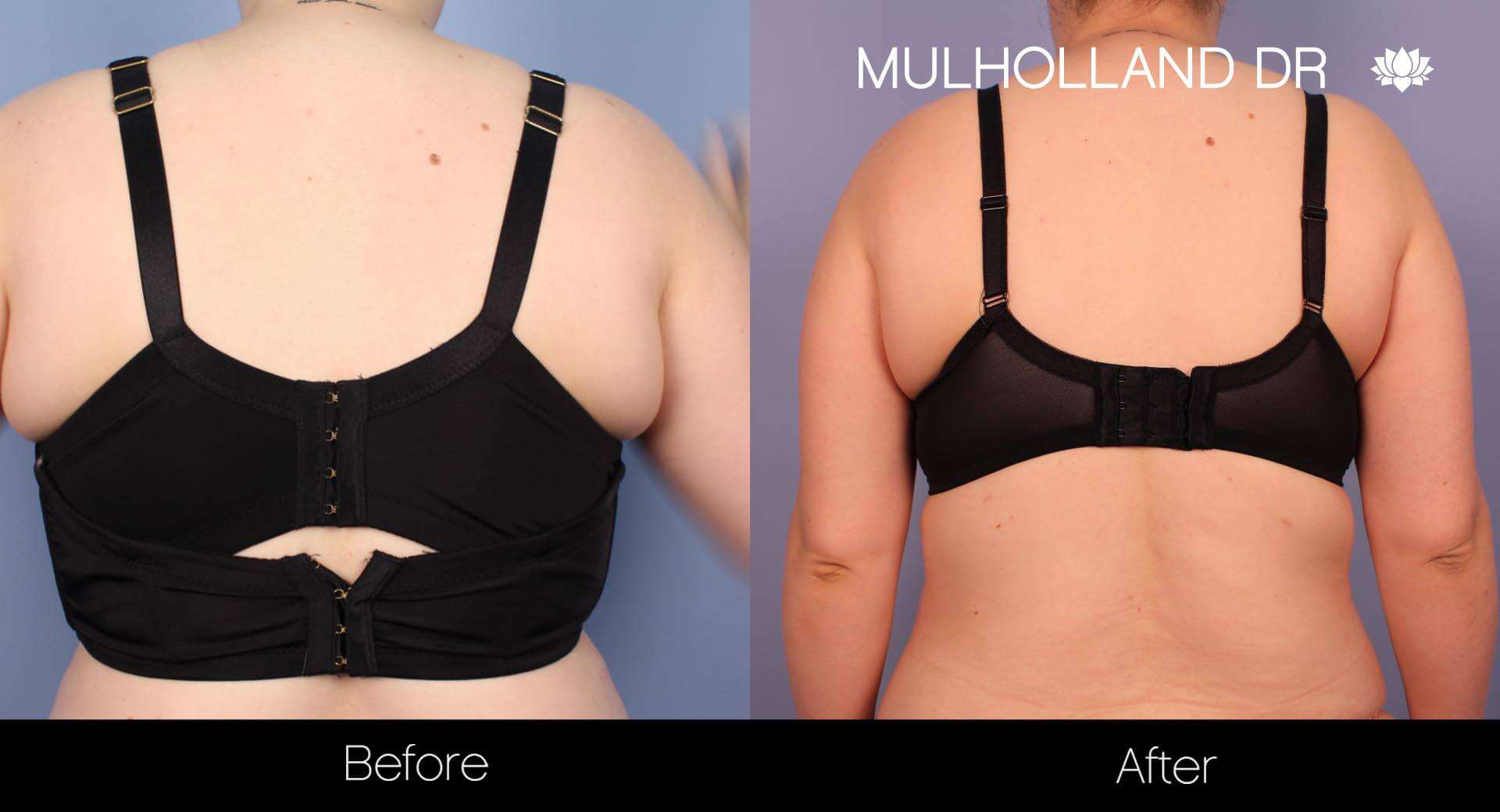 Vaser Lipo - Before and After Gallery – Photo 18