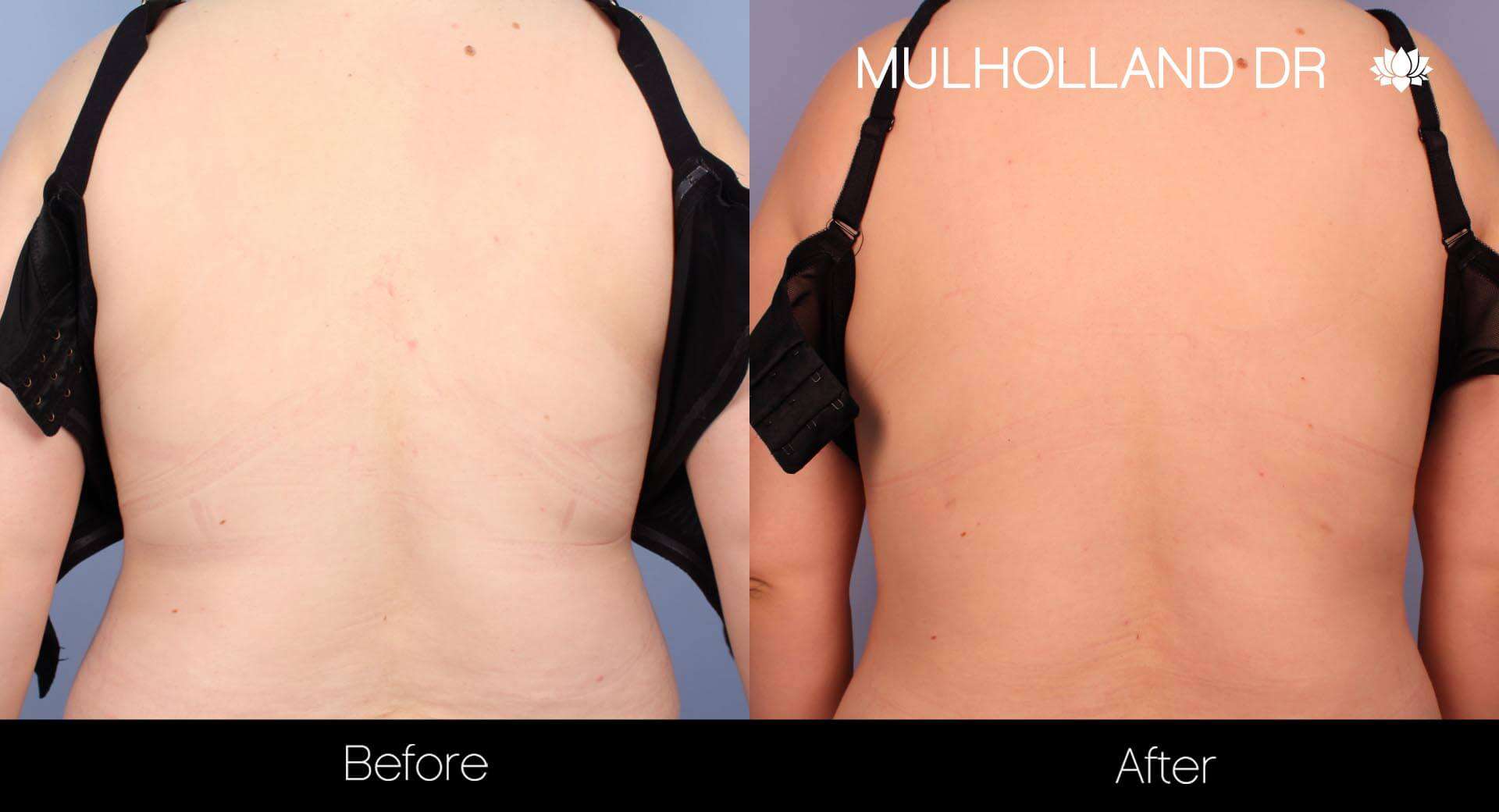Vaser Lipo - Before and After Gallery – Photo 19