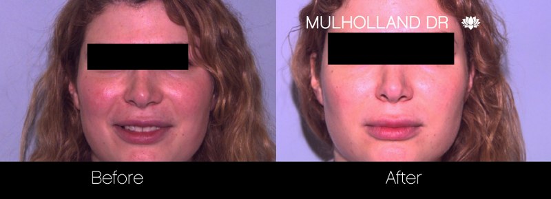 FotoFacial - Before and After Gallery – Photo 2