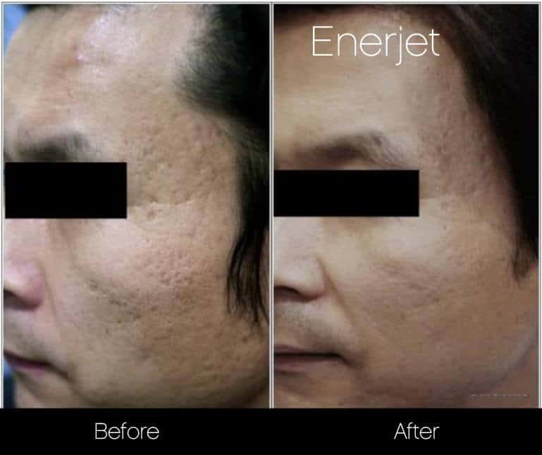 EnerJet Treatment - Before and After Gallery – Photo 1