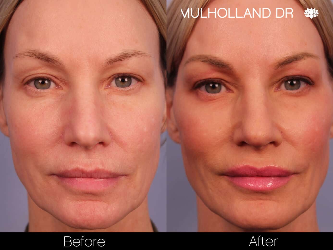 Non-Surgical Facelift - Before and After Gallery – Photo 1