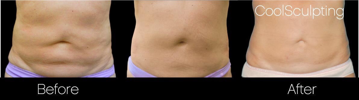 CoolSculpting - Before and After Gallery – Photo 1