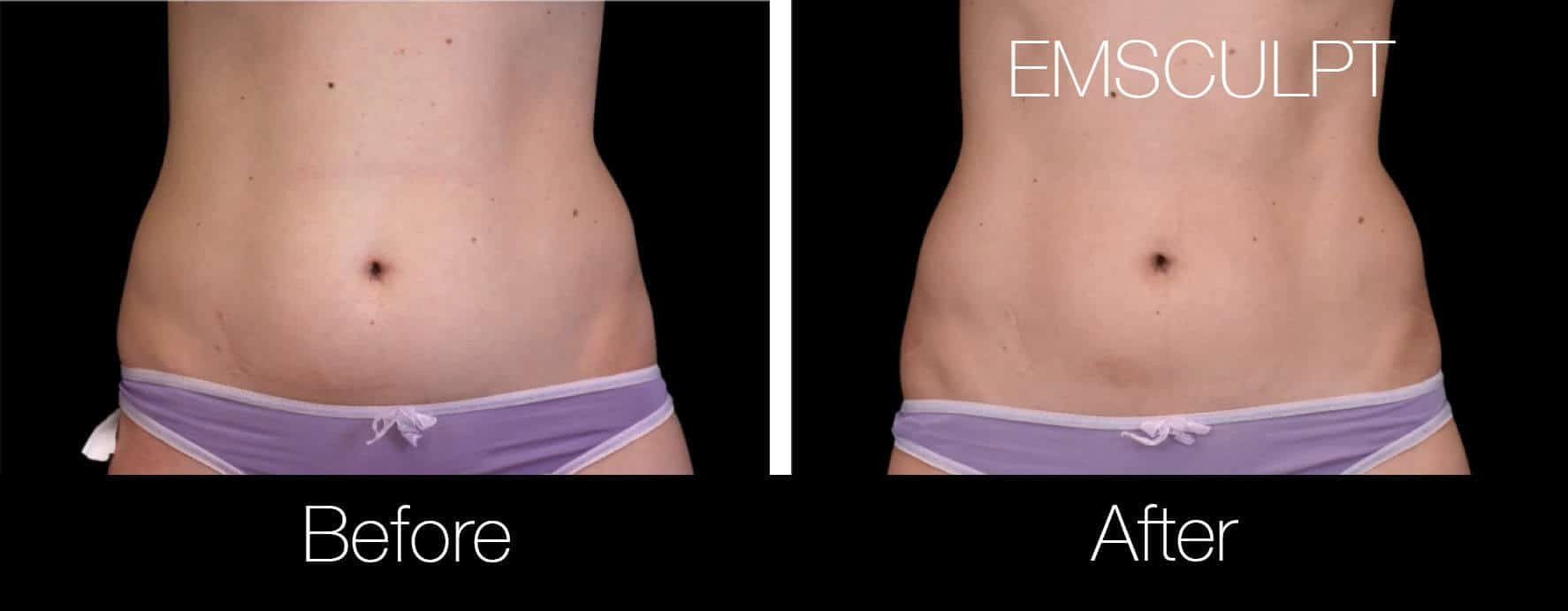 Emsculpt - Before and After Gallery – Photo 2