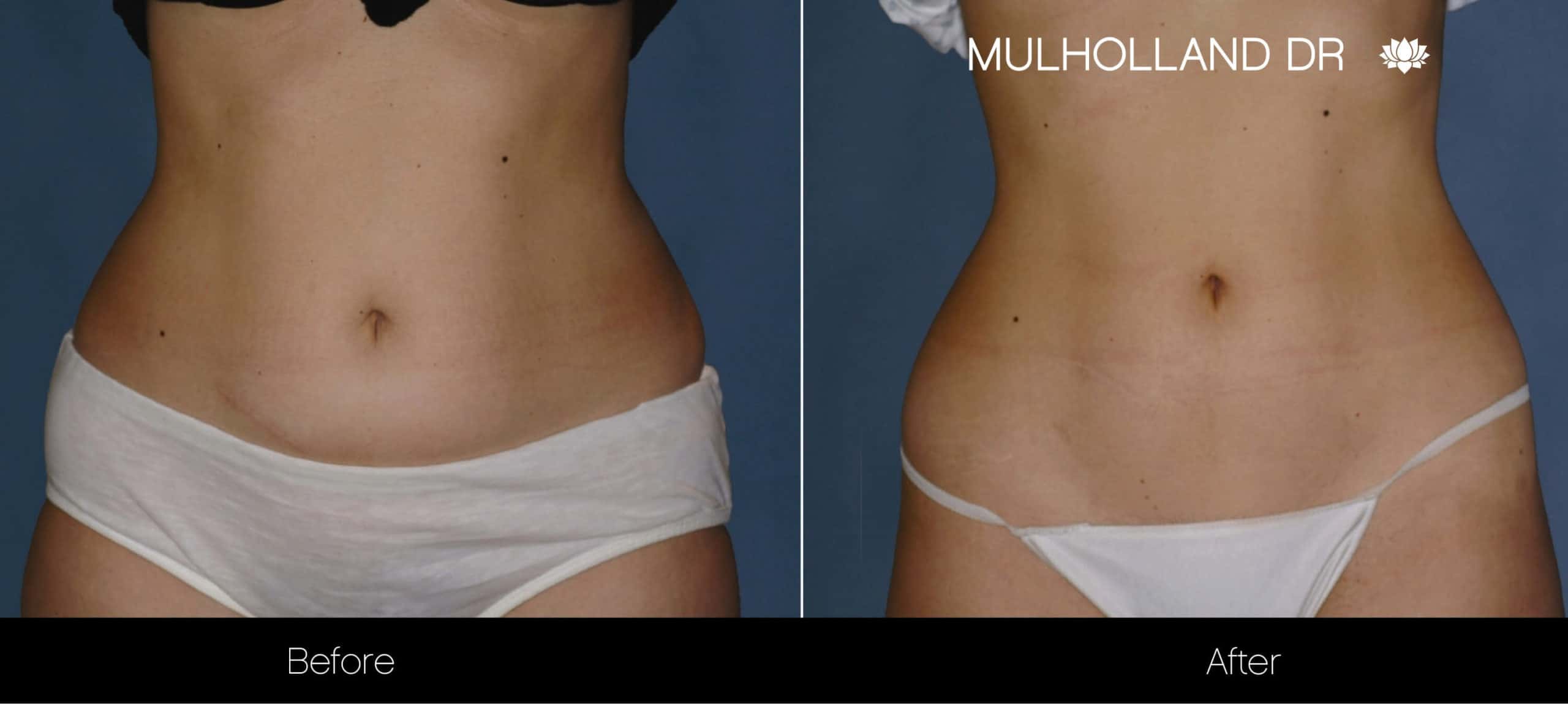 Non-Surgical Body Sculpting - Before and After Gallery – Photo 1