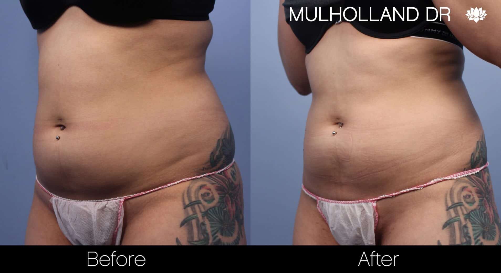 Non-Surgical Liposuction - Before and After Gallery – Photo 1