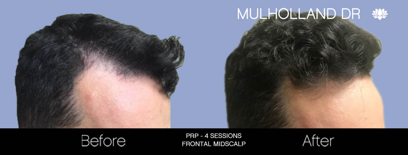 Non-Surgical Hair Restoration - Patient Before and After Gallery – Photo 1