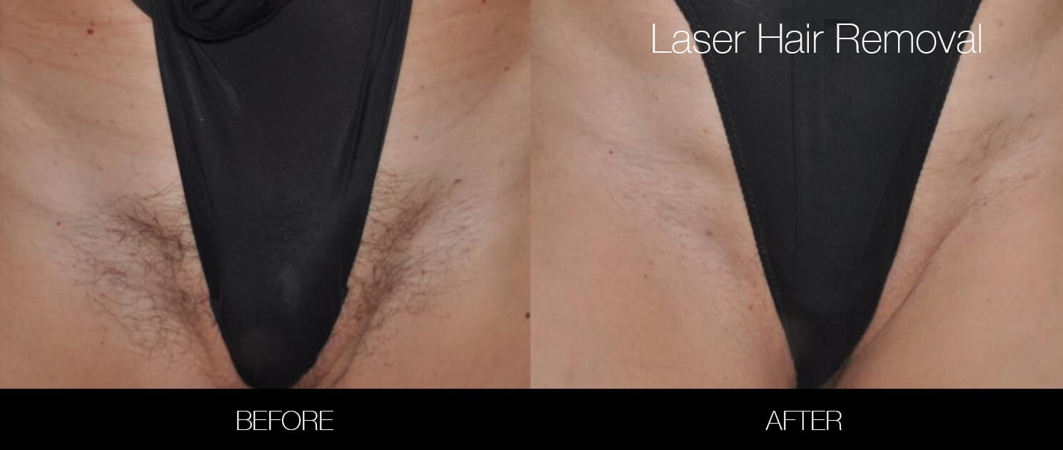 Cuantas sesiones de laser se necesitan para el pubis