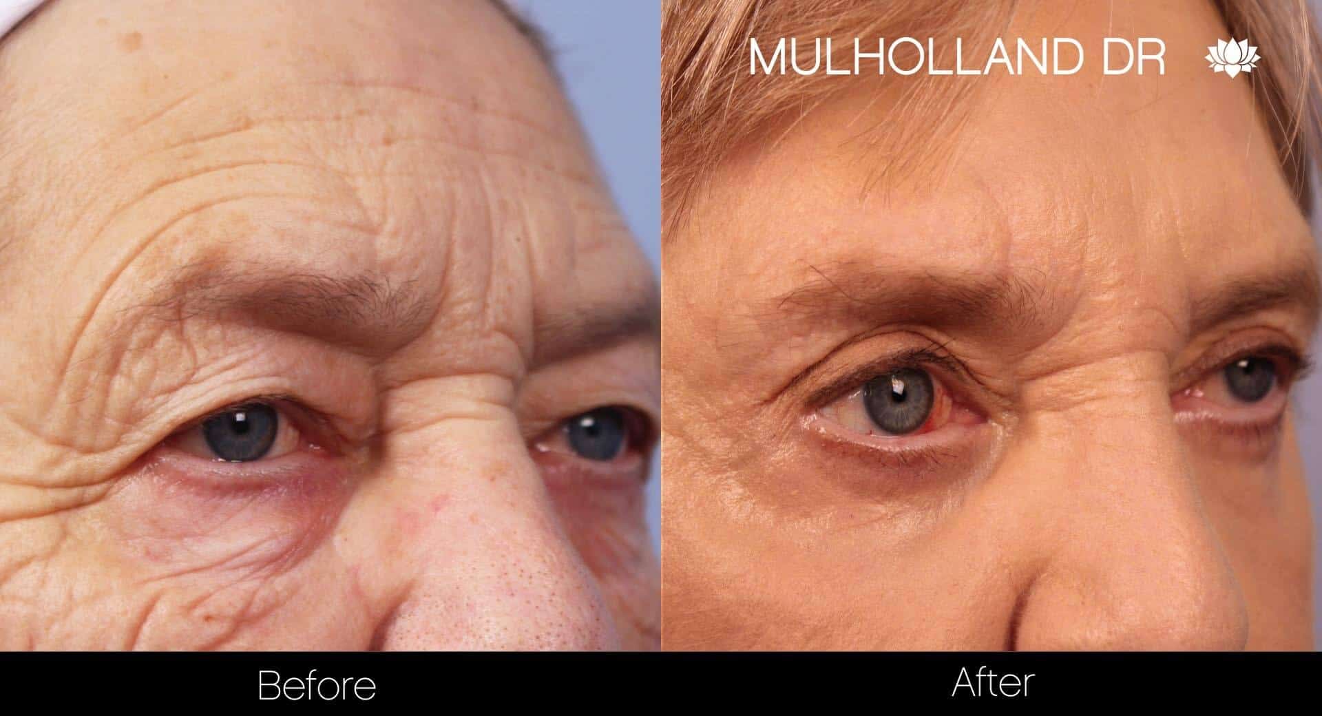 Facial Resurfacing and Rejuvenation - Before and After Gallery – Photo 1