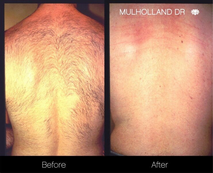 Laser Hair Removal - Patient Before and After Gallery – Photo 1