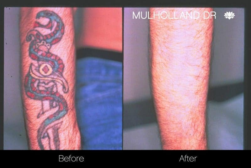 Laser Tattoo Removal - Before and After Gallery – Photo 1