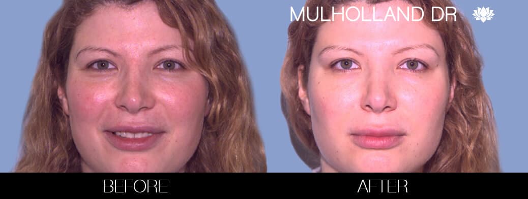 Rosacea Treatment - Patient Before and After Gallery – Photo 1