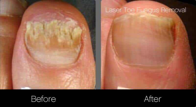 Toe Fungus Removal - Patient Before and After Gallery – Photo 1