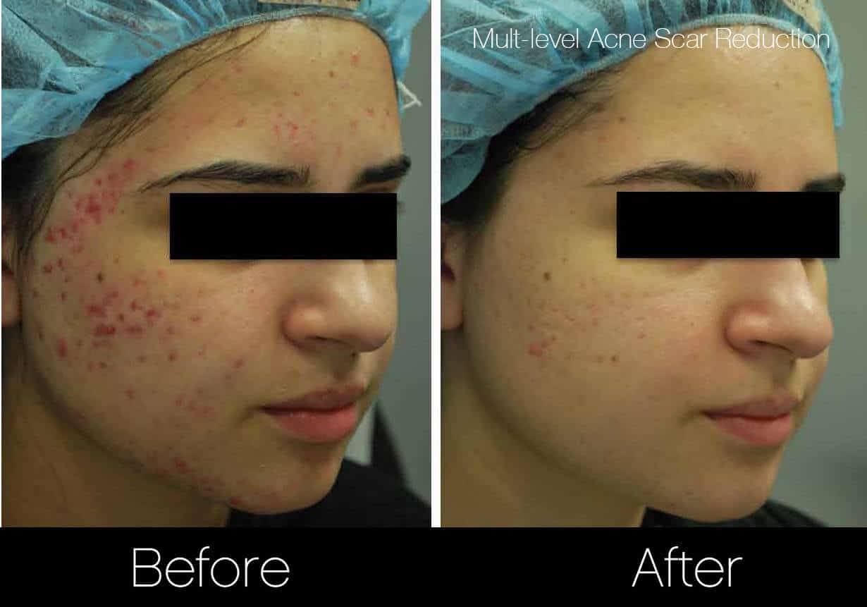 Acne Scar Treatments - Before and After Gallery – Photo 1