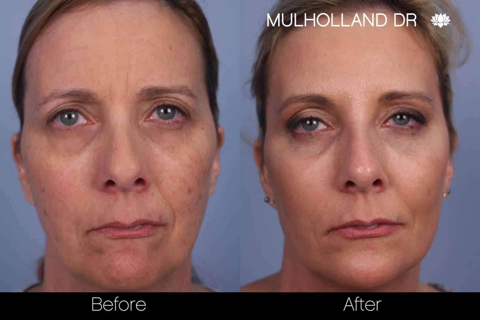 Microneedling Before And After Gallery Spamedica