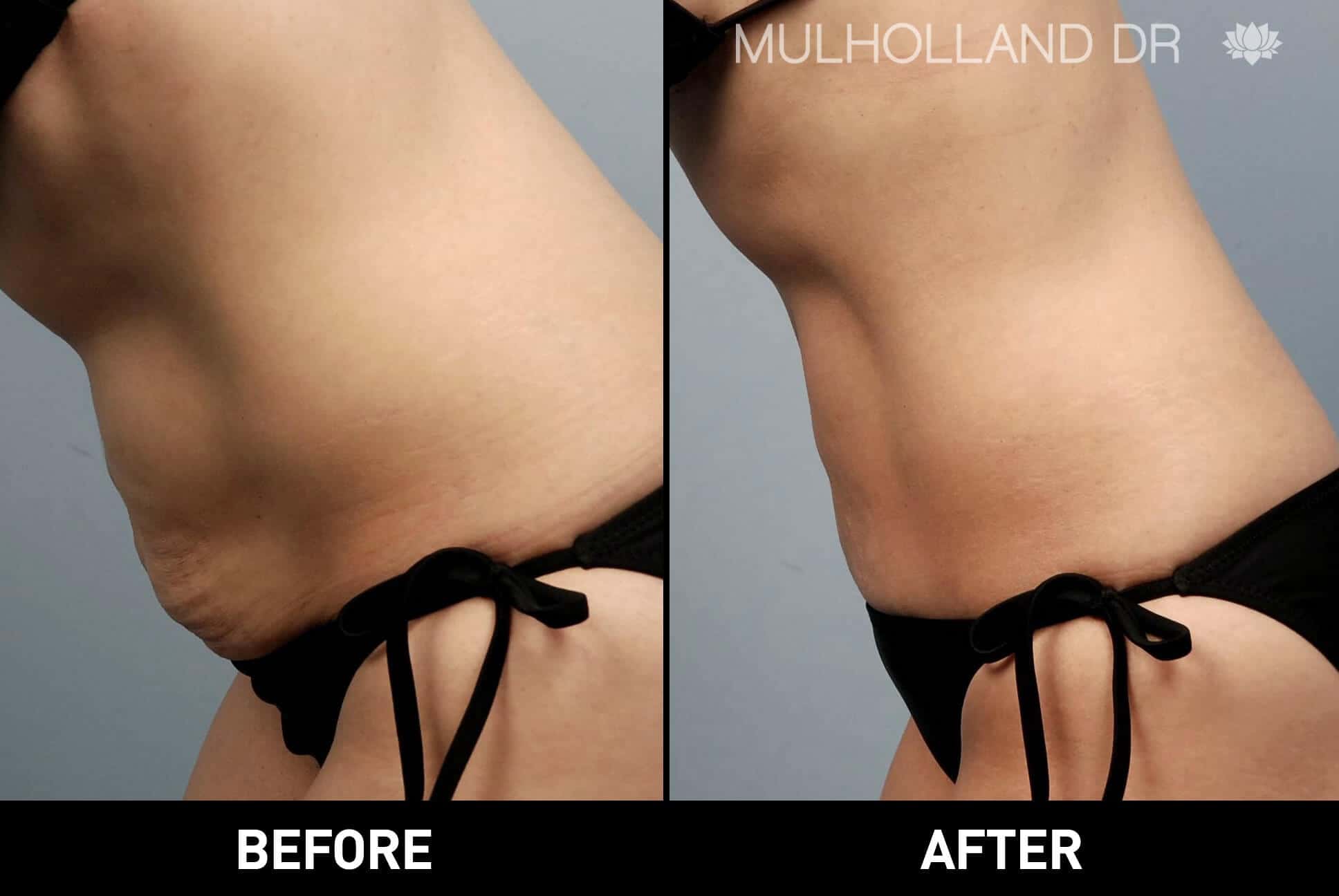 Smart Lipo - Before and After Gallery – Photo 1