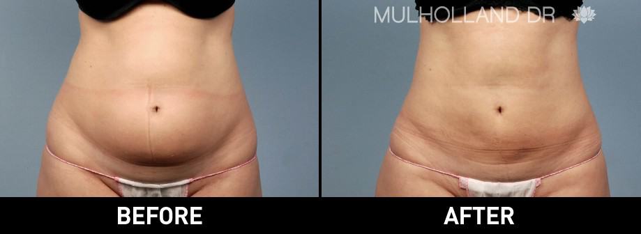 BodyTite Liposuction - Before and After Gallery – Photo 1