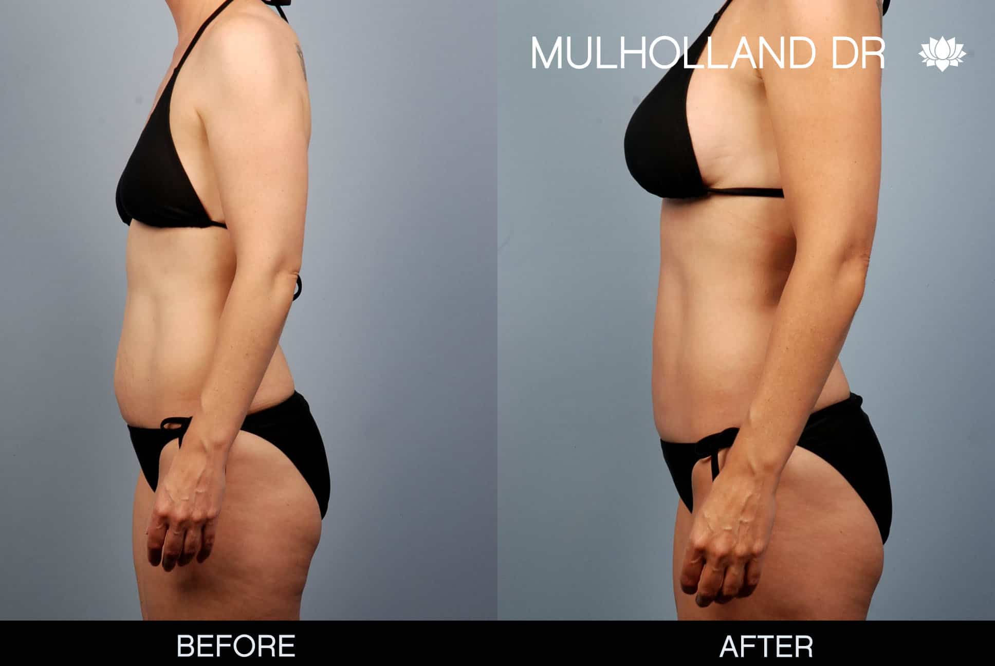 Mommy Makeover - Before and After Gallery – Photo 1
