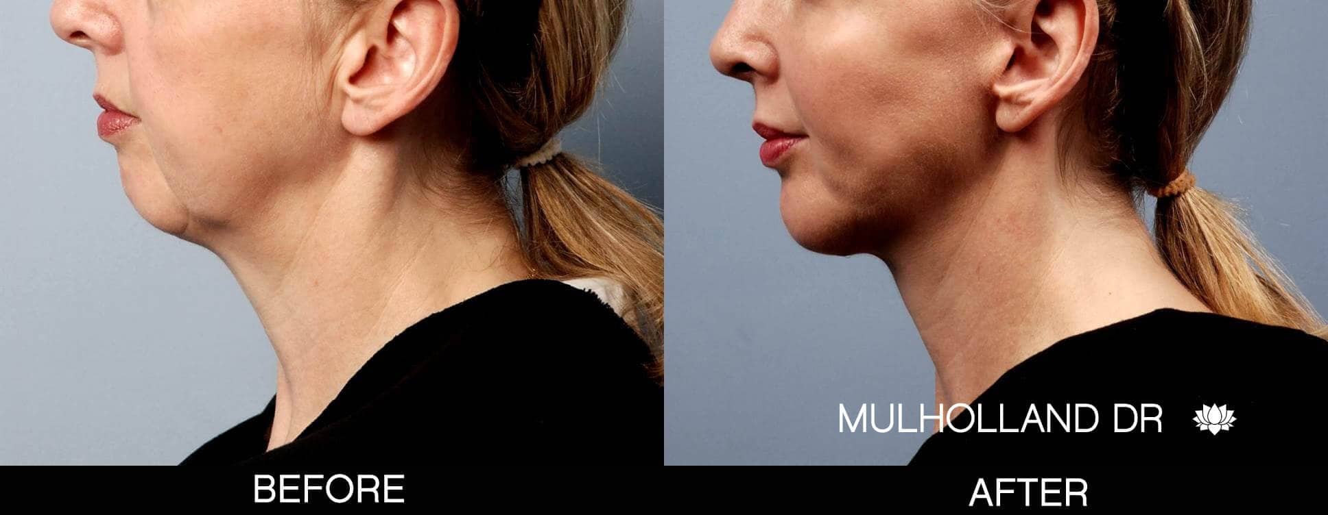 Chin Implant - Before and After Gallery – Photo 1