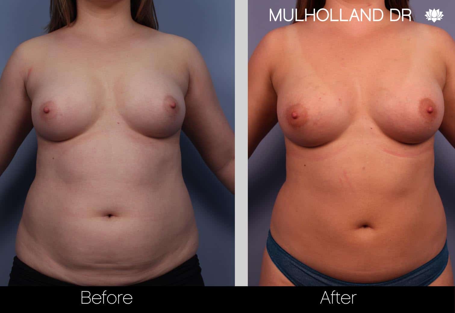 Fat Grafting Breast Augmentation - Before and After Gallery – Photo 1