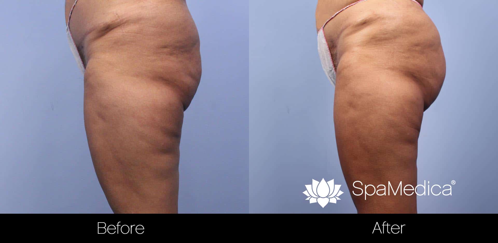 Brazilian Butt Lift - Before and After Gallery – Photo 1