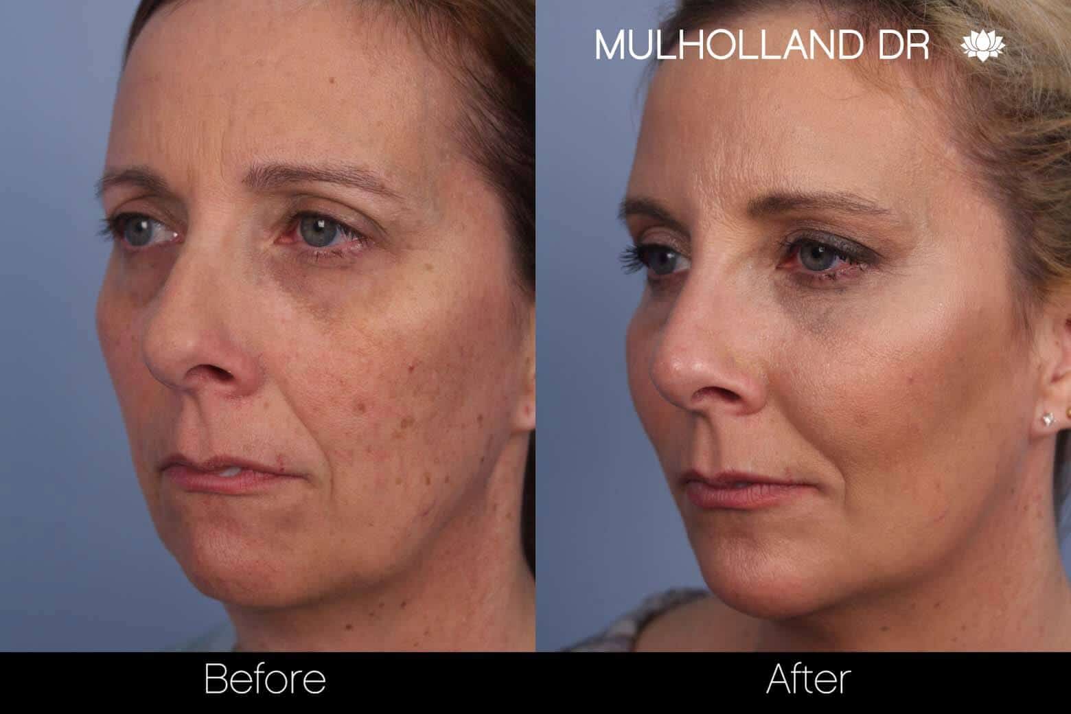 Microdermabrasion - Before and After Gallery – Photo 3
