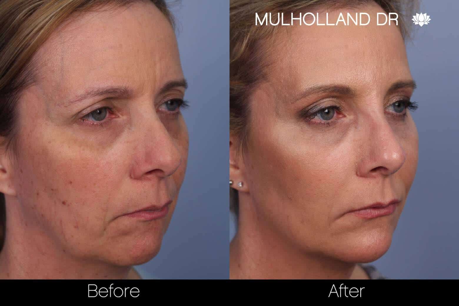 Microdermabrasion - Before and After Gallery – Photo 4