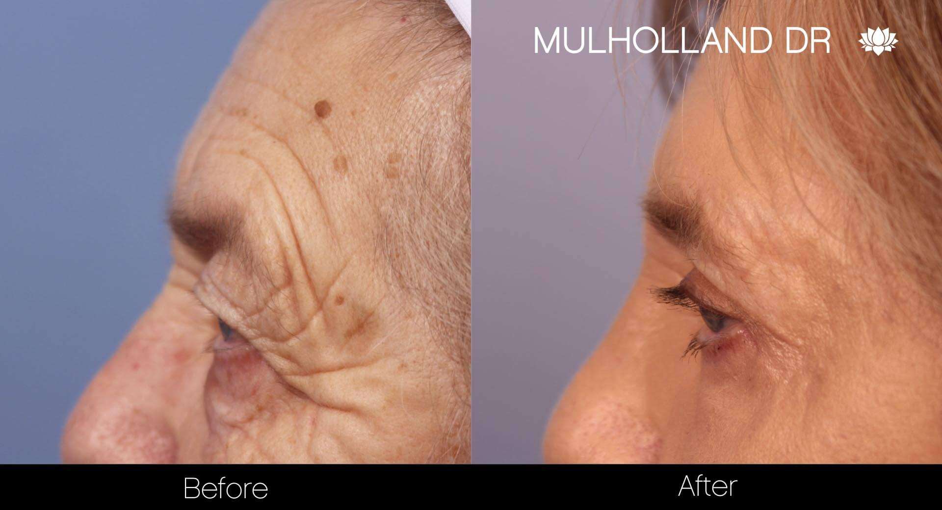 Facial Resurfacing and Rejuvenation - Before and After Gallery – Photo 5