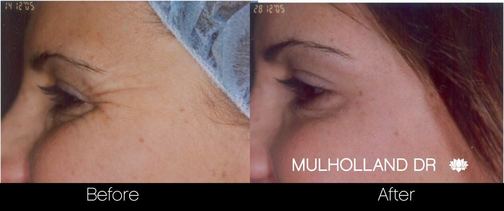 Botox Before and After Gallery - Photo 25