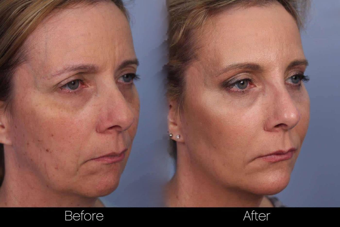 FotoFacial - Before and After Gallery – Photo 6