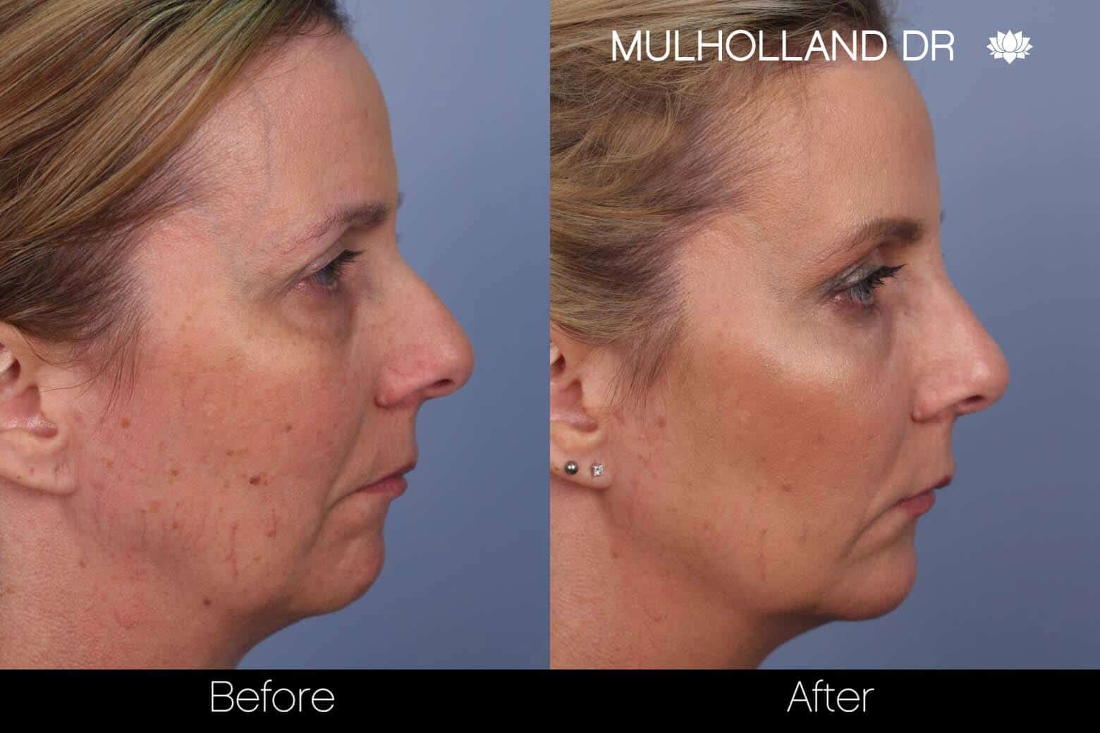 Microdermabrasion - Before and After Gallery – Photo 5
