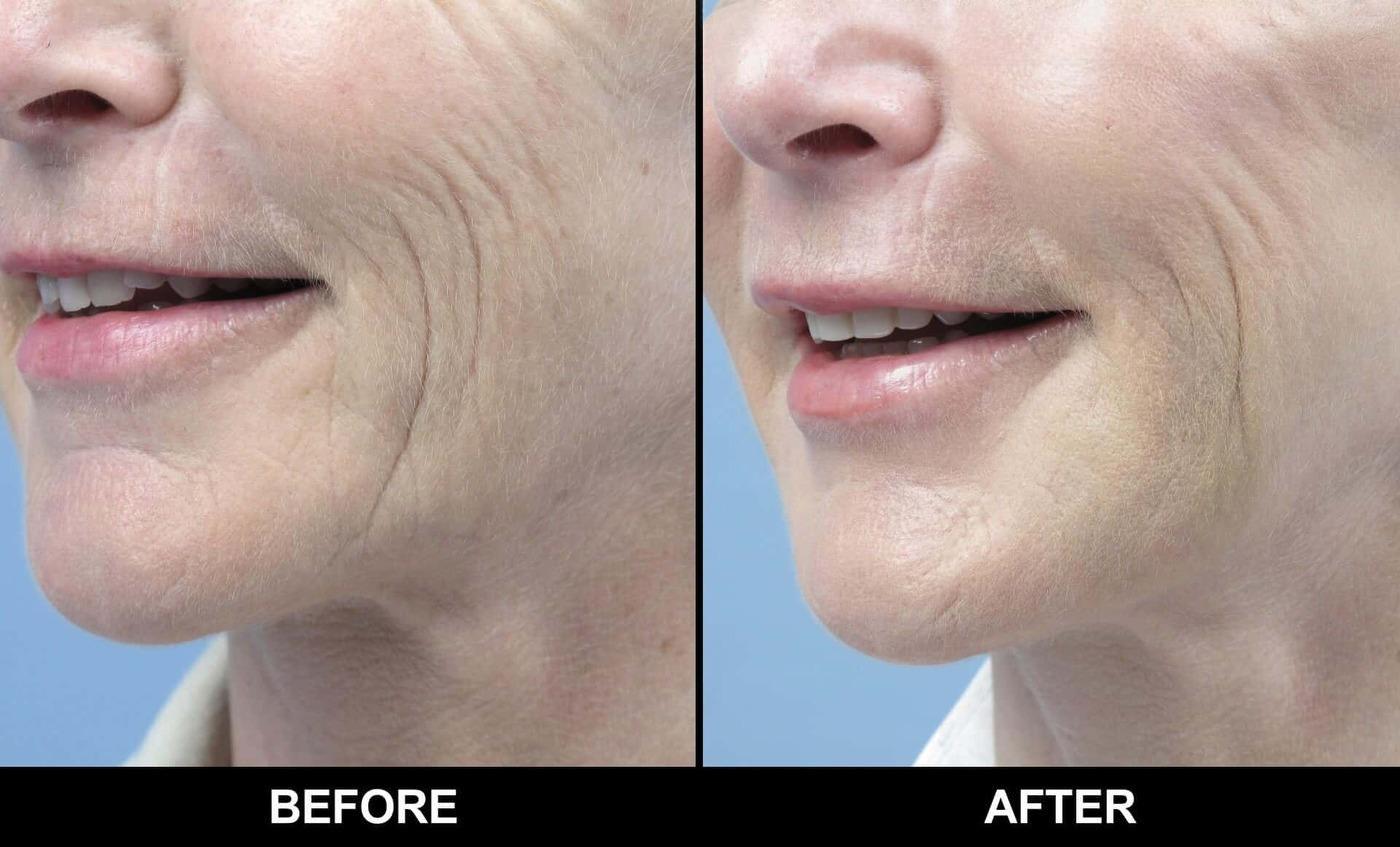 Microdermabrasion - Before and After Gallery – Photo 14