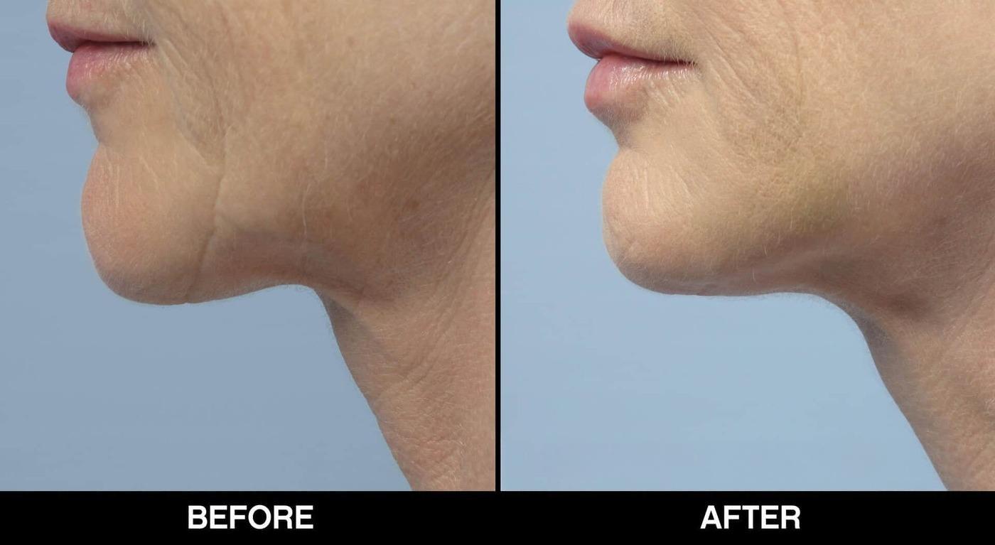 Microdermabrasion - Before and After Gallery – Photo 15