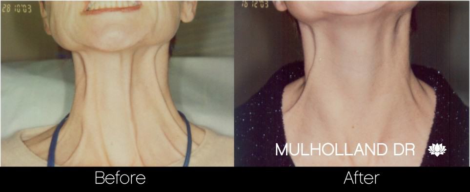 Botox Before and After Gallery – Photo 28