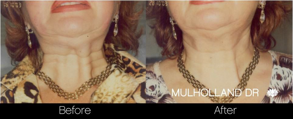 Botox Before and After Gallery – Photo 29