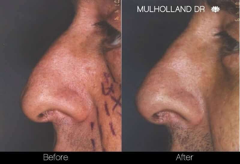 5 Minute Nose Job - Before and After Gallery – Photo 2