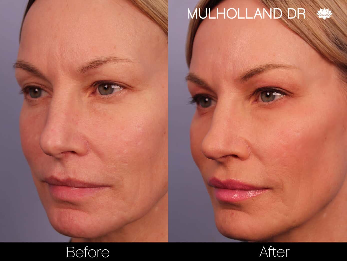 Non-Surgical Facelift - Before and After Gallery – Photo 3
