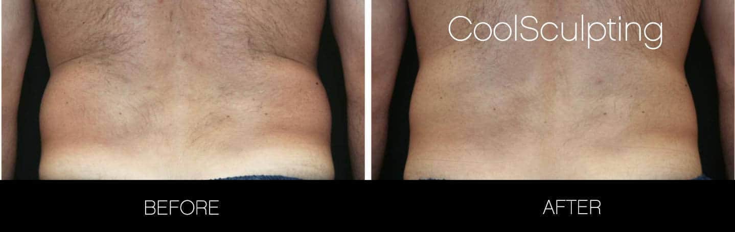 CoolSculpting - Before and After Gallery – Photo 2