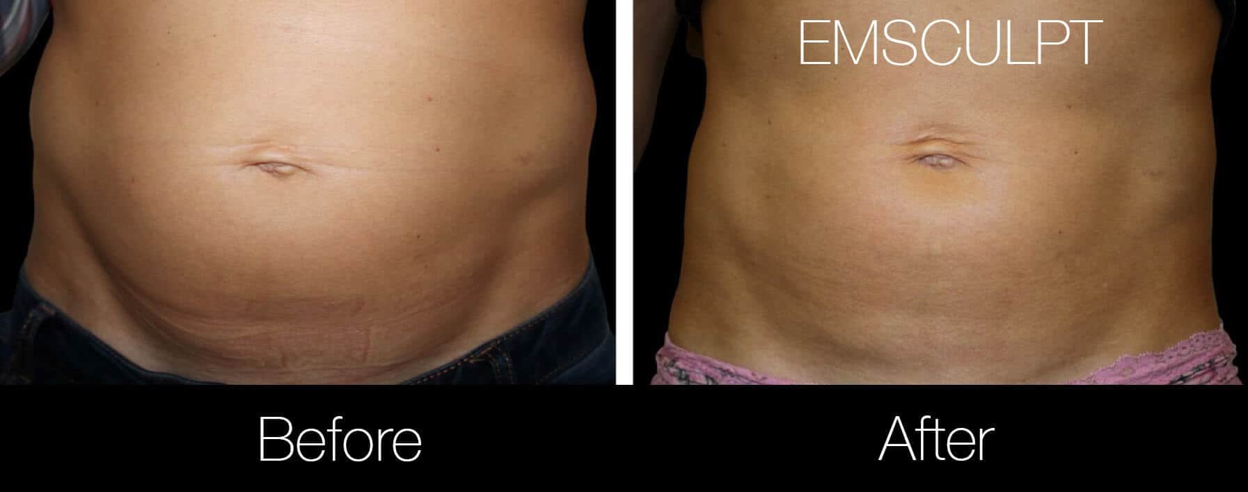 Emsculpt - Before and After Gallery – Photo 2