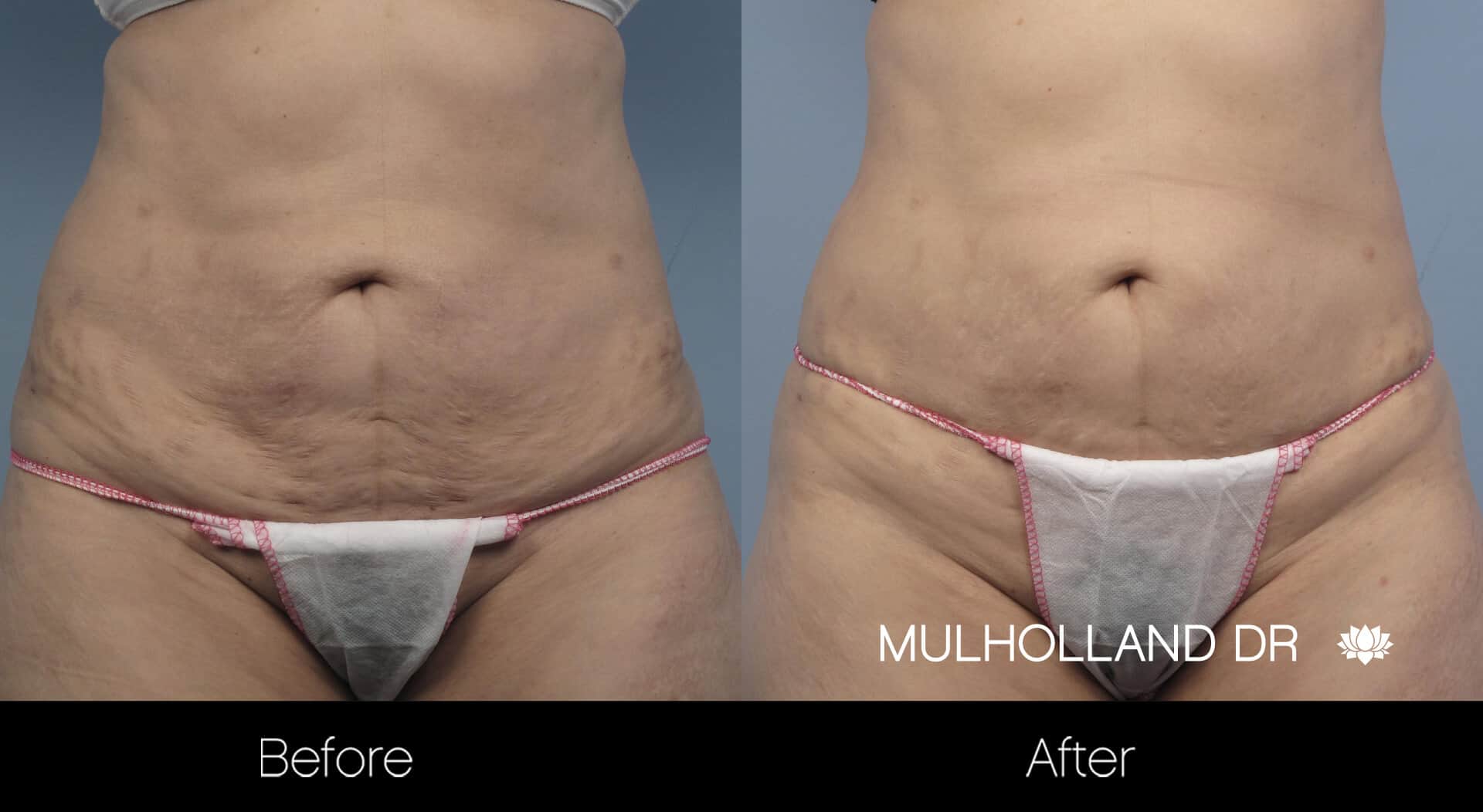 Non-Surgical Liposuction - Before and After Gallery – Photo 4