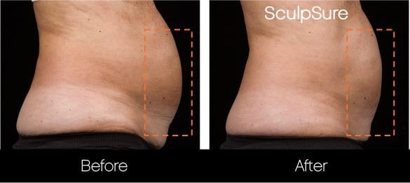 SculpSure - Before and After Gallery – Photo 4