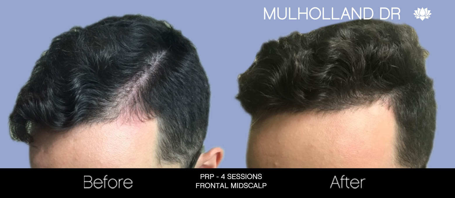 Non-Surgical Hair Restoration - Patient Before and After Gallery – Photo 2