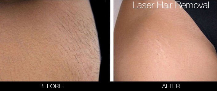 laser hair removal prices toronto